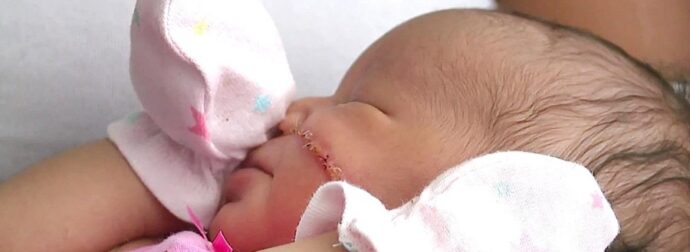 Νεογέννητο χρειάστηκε 13 ράμματα στο πρόσωπο μετά από ατύχημα στην καισαρική