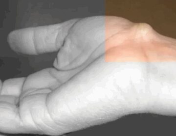Καθημερινές Συνήθειες Που Μπορεί Να Προκαλέσουν Αυτή Τη Νόσο