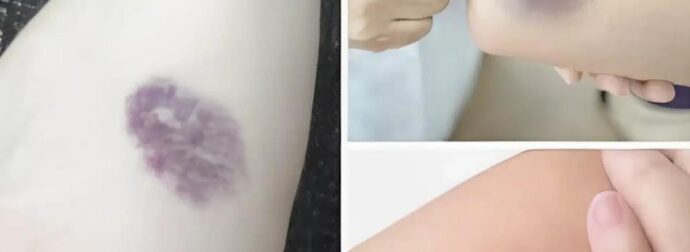 ΠΡΟΣΟΧΗ! Αν εμφανιστούν τέτοιες μελανιές στο σώμα σας, σημαίνει ότι έχετε…