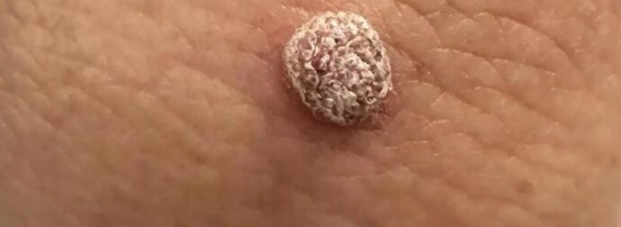 Αχ, έχω ένα ξεραμένο εξόγκωμα στον αγκώνα. Μπορώ να το αφαιρέσω μόνος/η μου στο σπίτι ή πρέπει να δω γιατρό; Φαίνεται χάλια.