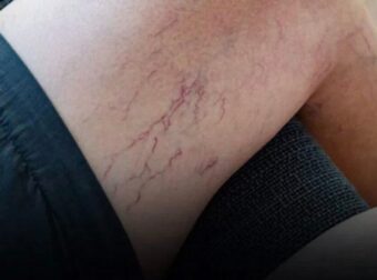Φλέβες στα πόδια που γίνονται μωβ; Nα τι πρέπει να γνωρίζετε