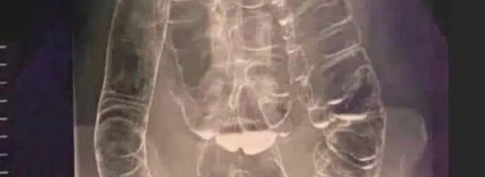 Χρόνια δυσκοιλιότητα – Μια σιωπηλή απειλή για την υγεία του πεπτικού συστήματος