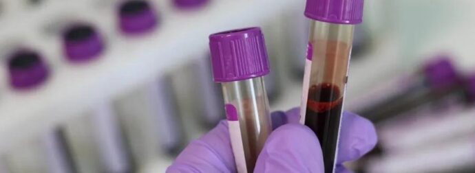 Noσnλεuεται στη ΜΕΘ σε Kpiσιμn κατάσταση