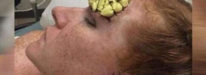 39χρονη έμεινε έγκυος και φύτρωσε στο μέτωπό της κάτι παράξενο – Μόλις της το αφαίρεσαν οι γιατροί «πάγωσαν»