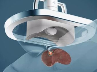 Ρομπότ στις ΗΠΑ καταστρέφει τον καρκίνο με υπέρηχο – Η θεραπεία γίνεται χωρίς κανένα άνοιγμα του κορμιού