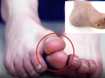 Πολλοί άνθρωποι με μη φυσιολογικά επίπεδα σακχάρου στο αiμα δεν αναγνωρίζουν τα προειδοποιητικά σήματα που στέλνει το σώμα τους