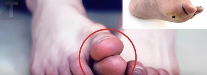 Πολλοί άνθρωποι με μη φυσιολογικά επίπεδα σακχάρου στο αiμα δεν αναγνωρίζουν τα προειδοποιητικά σήματα που στέλνει το σώμα τους