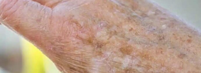 Γιατί εμφανίζονται κηλίδες στα χέρια μας και πώς μπορούμε να τις εξαλείψουμε;