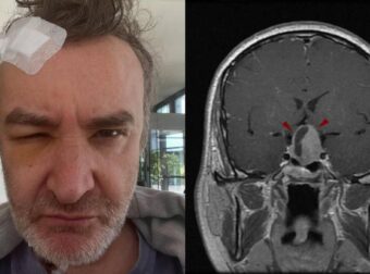 Νίκος Ορφανός: Τι είναι το κρανιοφαρυγγίωμα που αντιμετώπισε – Ποιοι επηρεάζονται, οι κυριότερες θεραπείες