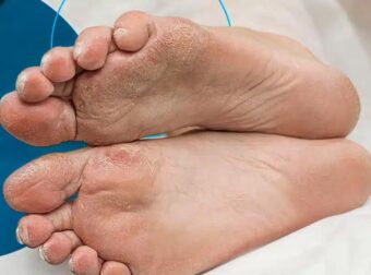 Προειδοποίηση: Αν το έχετε αυτό στα πόδια σας, μπορεί να είναι σημάδι