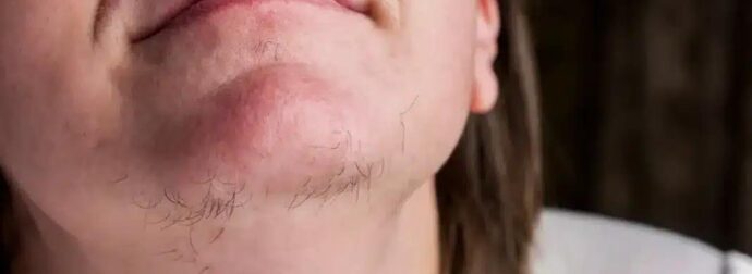 Αν είστε γυναίκα με γένια στο σαγόνι να τι σημαίνει για εσάς – Αυτές οι τρίχες στο…