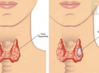 Οι περιπτώσεις καρκίνου του θυρεοειδούς αuξάνονται ραγδαία. Οι γιατροί σας συμβουλεύουν να τρώτε λιγότερο από αυτές τις τροφές