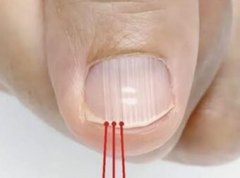 Εάν έχετε αυτές τις γραμμές στα νύχια σας μετά τα 40, είναι ένα σαφές σημάδι ότι…