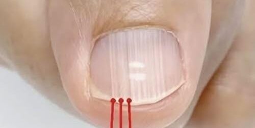 Εάν έχετε αυτές τις γραμμές στα νύχια σας μετά τα 40, είναι ένα σαφές σημάδι ότι…