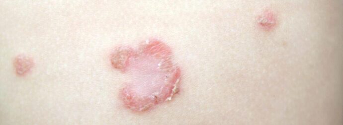 Απλές συμβουλές για να αποφύγετε την μυκητίαση του δέρματος