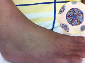 «Καμπανάκι» επιστημόνων για τον ιό τσικουνγκούνια – Φόβοι για νέα πανδημία