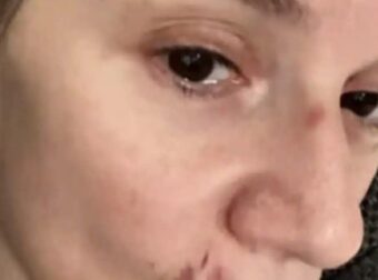 Με μαυρισμένο μάτι και με αίματα στο πρόσωπο η Πέγκυ Τρικαλιώτη