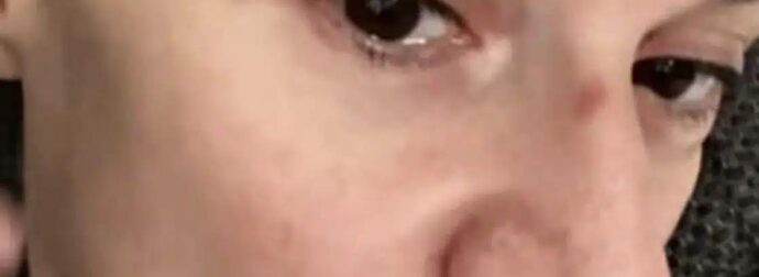 Με μαυρισμένο μάτι και με αίματα στο πρόσωπο η Πέγκυ Τρικαλιώτη