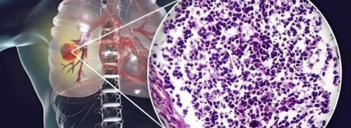 Ο αόρατος Kivδuvoς – Τι κοινό υλικό κουζίνας συνδέεται με Kαpκivo πνεύμονα – Πpoσoxn στο σπίτι σας