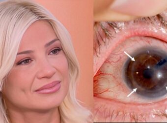 Φαίη Σκορδά: Τι είναι ο κερατόκωνος με τον οποίο έχει διαγνωσθεί – Συμπτώματα, αιτίες και διάγνωση