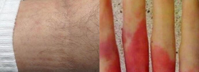 Ανακοπή καρδιάς: 6 προειδοποιητικά σημάδια που θα νιώσετε λίγες μέρες πριν