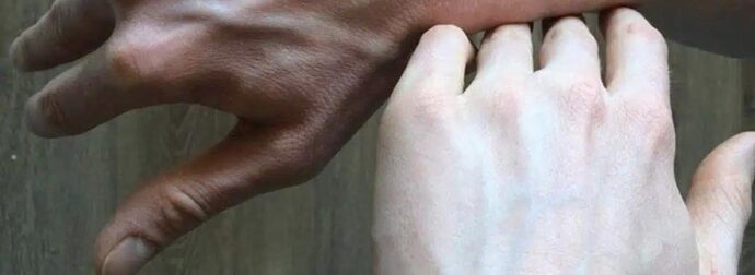 Αν δείτε κάποιον με διογκωμένες φλέβες, πρέπει να του πείτε αυτά τα πράγματα