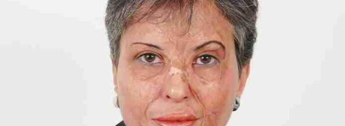 Καλλιόπη Αθανασιάδη: Επιβίωσε από φριχτό ατύχημα, έγινε κορυφαία χειρουργός και μάχεται για τα δικαιώματα των γυναικών