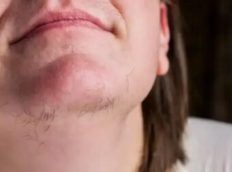 Αν είστε γυναίκα με γένια στο σαγόνι να τι σημαίνει για εσάς – Αυτές οι τρίχες στο…