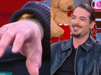 «Το χαϊδέψανε και μου είπανε “μπαμπά, το μιμί πέρασε”»: Ο Άρης Μουγκοπέτρος έδειξε στο «Πρωινό» τα πρόσθετα δάχτυλά του