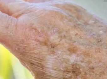 Γνωρίζατε ότι αν εμφανιστούν κηλίδες στα χέρια σας, είναι ξεκάθαρο σημάδι ότι…