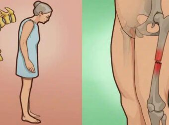 Οστεοπόρωση: Το ελληνικό βότανο που δυναμώνει και προστατεύει τα κόκκαλα