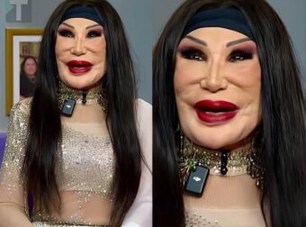 Ήταν μια διάσημη ηθοποιός που εμφανίστηκε σε περίπου 100 ταινίες, αλλά ένα τραγικό λάθος άλλαξε άρδην την εμφάνισή της