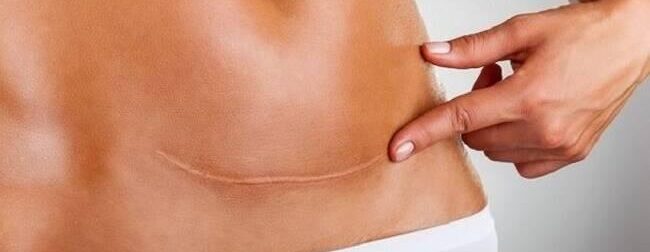 3 πράγματα που όλοι μας πρέπει να ξέρουμε για τις γυναίκες που έχουν κάνει καισαρική