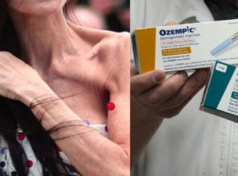 Αυτό που κανείς δεν λέει για το Ozempic: Τι συμβαίνει όταν κόβεις τις ενέσεις